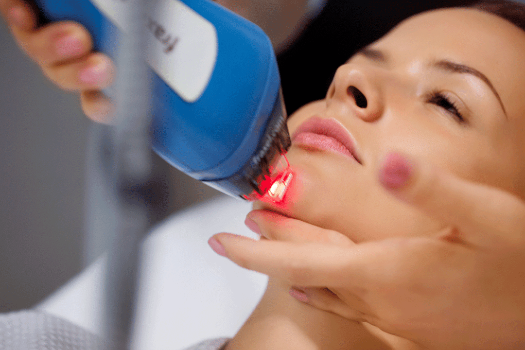lasersko podmlađivanje kože lica