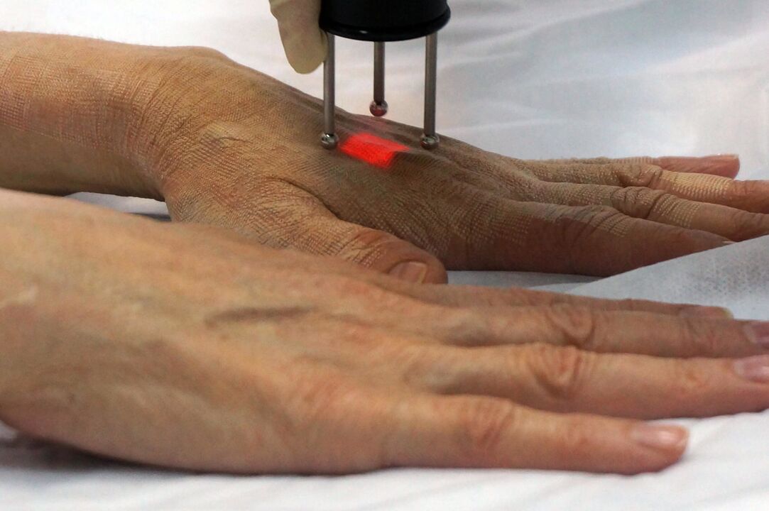 Lasersko podmlađivanje ruku neablativnom metodom