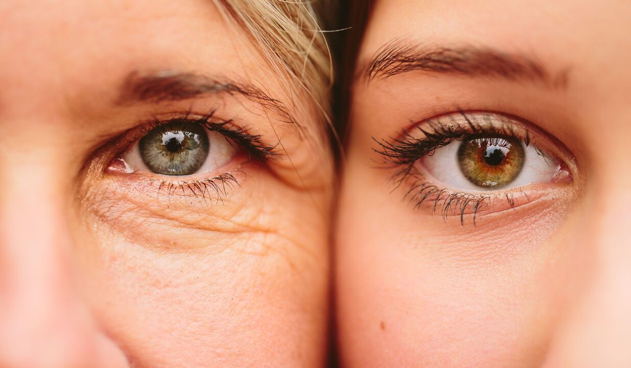 znakovi starenja oko očiju