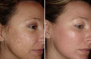 lasersko pomlađivanje kože lica prije i nakon fotografija